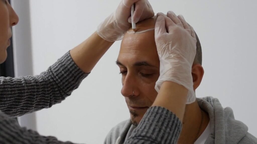 Scalp Micropigmentation Dubai