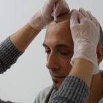 Scalp Micropigmentation Dubai