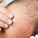 Scalp Micropigmentation Dubai