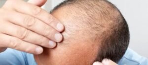 Scalp Micropigmentation Dubai