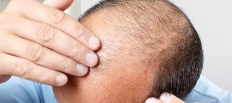 Scalp Micropigmentation Dubai