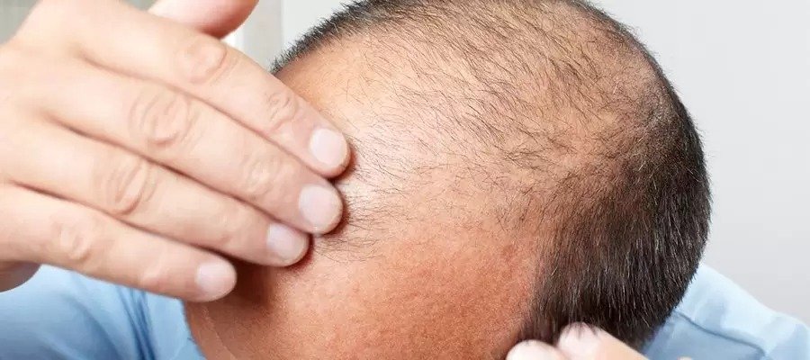 Scalp Micropigmentation Dubai