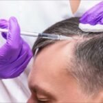 Stem Cell Hair Transplant in Dubai
