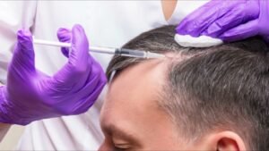 Stem Cell Hair Transplant in Dubai