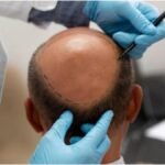 Hair Transplant Ras Al Khaimah