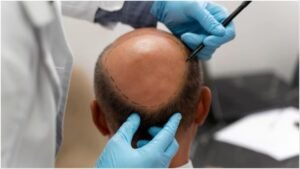 Hair Transplant Ras Al Khaimah