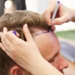 Hair Replacement in Dubai