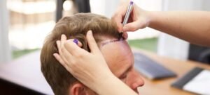 Hair Replacement in Dubai
