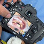 Implant dentaire Casablanca