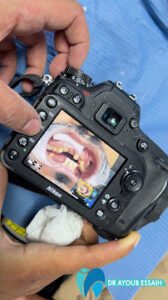 Implant dentaire Casablanca