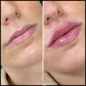 dermal fillers in dubai