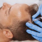 Hair Replacement in Dubai