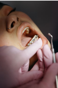 Invisalign vs. Braces: Which Is Better for Achieving Your Ideal Smile?