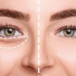 Under Eye Fillers Explained Benefits