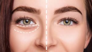 Under Eye Fillers Explained Benefits