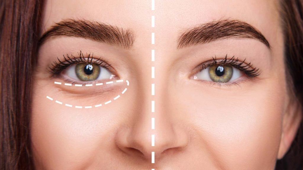 Under Eye Fillers Explained Benefits