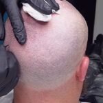 Scalp Micropigmentation Dubai