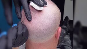 Scalp Micropigmentation Dubai