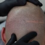 Scalp Micropigmentation Dubai