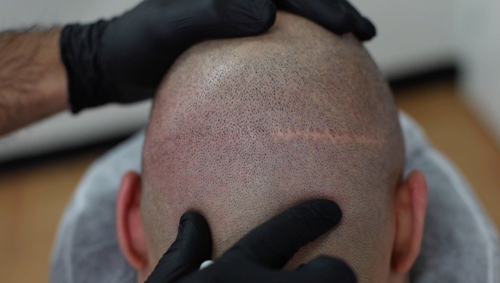 Scalp Micropigmentation Dubai