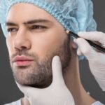 Beard Hair Transplant in Dubai