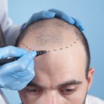 Hair Transplant in Dubai