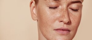 Pigmentation Treatment in Dubai for Freckles and Age Spots