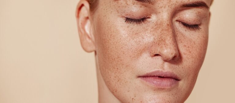 Pigmentation Treatment in Dubai for Freckles and Age Spots