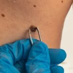 skin-tag-removal