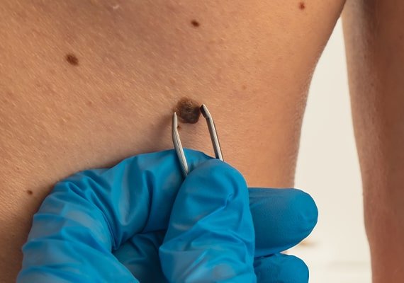 skin-tag-removal