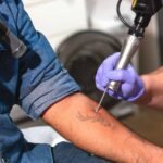 Dermatologists Explain the Laser Tattoo Removal Process