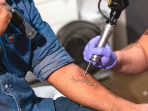 Dermatologists Explain the Laser Tattoo Removal Process