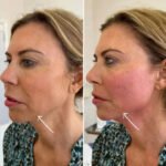 Best Doctors in dubai for Endolift Face and Neck Tightening