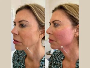 Best Doctors in dubai for Endolift Face and Neck Tightening