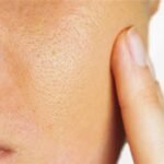 Large Pores Treatment Cost Pricing Guide for Popular Procedures