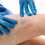 Sclerotherapy in Dubai