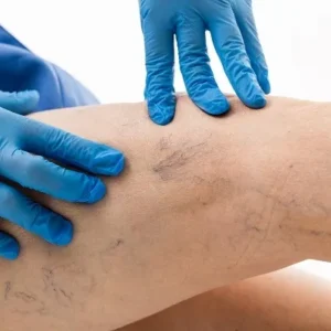 Sclerotherapy in Dubai