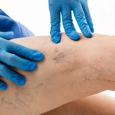 Sclerotherapy in Dubai