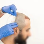 Robotic Hair Transplant in Dubai