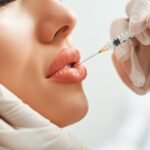 Botox Lip Flip in Dubai