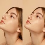 Rhinoplasty in Dubai