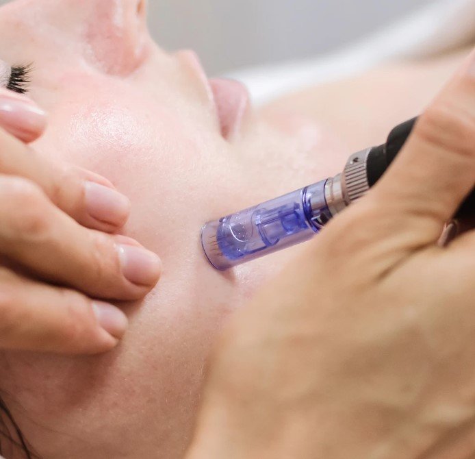 Microneedling In Manchester