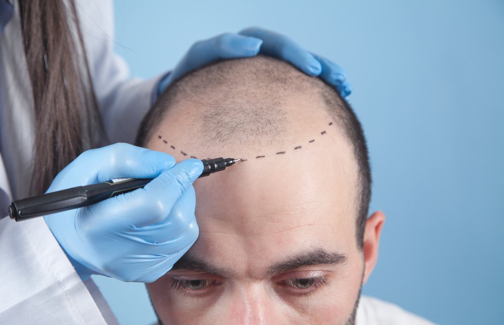 Hair Replacement in Dubai